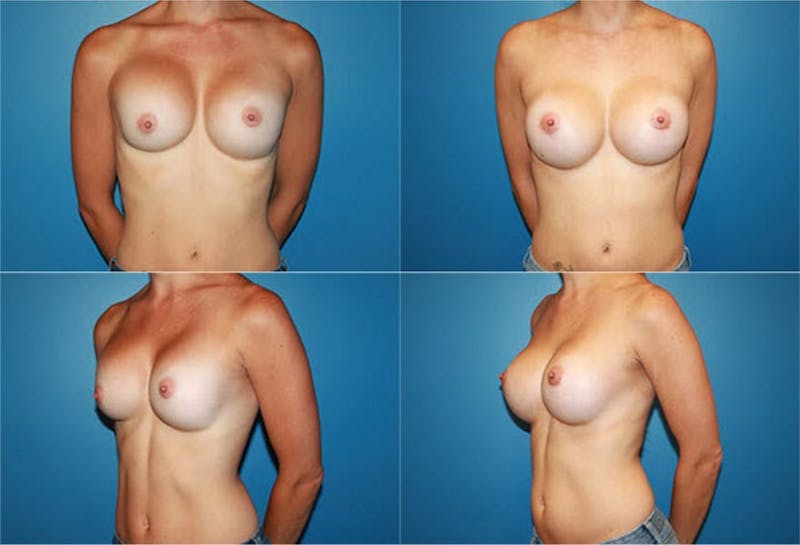 Breast Revision Surgery Before & After Gallery - Patient 2158858 - Image 1