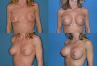 Asymmetry Before & After Gallery - Patient 2393797 - Image 1