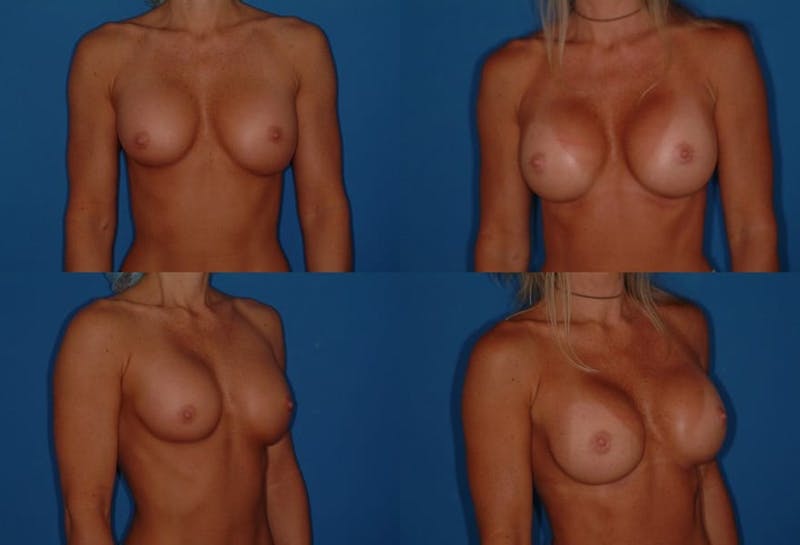 Breast Revision Surgery Before & After Gallery - Patient 2158860 - Image 1