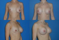 Asymmetry Before & After Gallery - Patient 2393799 - Image 1