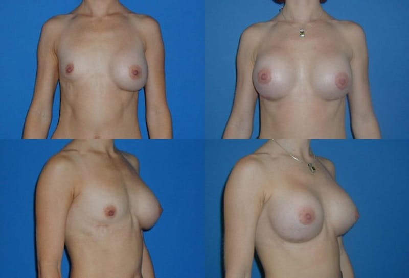 Asymmetry Before & After Gallery - Patient 2393799 - Image 1