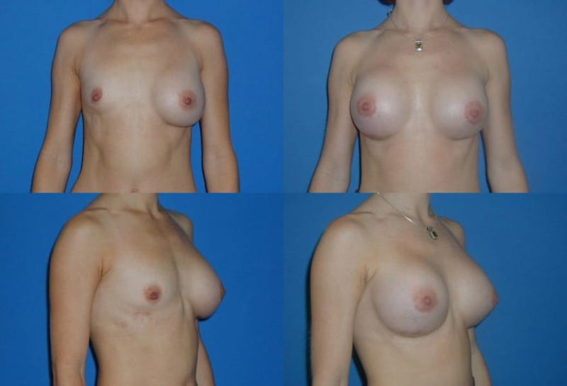 Breast Revision Surgery Before & After Gallery - Patient 2158861 - Image 1