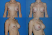 Breast Revision Surgery Before & After Gallery - Patient 2158861 - Image 1