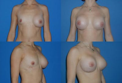 Breast Revision Surgery Before & After Gallery - Patient 2158861 - Image 1