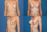 Asymmetry Before & After Gallery - Patient 2393800 - Image 1