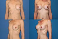 Breast Revision Surgery Before & After Gallery - Patient 2158862 - Image 1