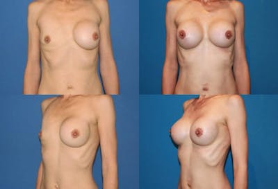 Breast Revision Surgery Before & After Gallery - Patient 2158862 - Image 1