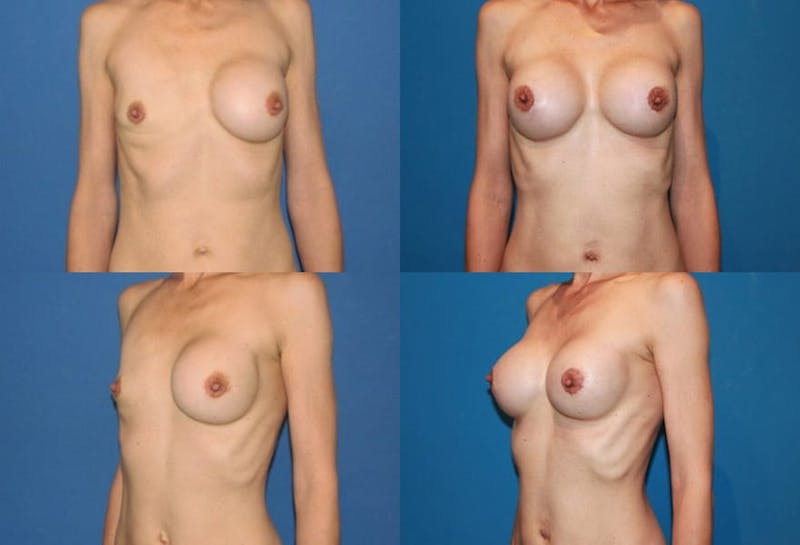 Breast Revision Surgery Before & After Gallery - Patient 2158862 - Image 1