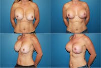 Asymmetry Before & After Gallery - Patient 2393804 - Image 1