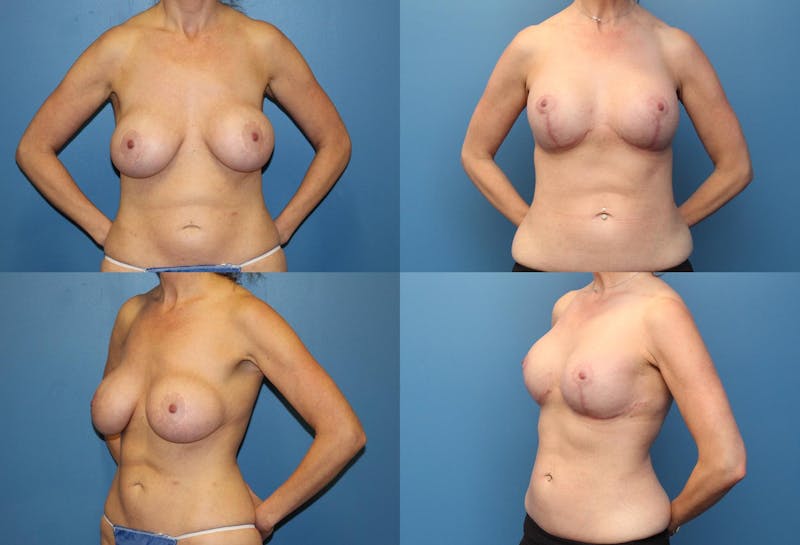 Breast Revision Surgery Before & After Gallery - Patient 2158867 - Image 1