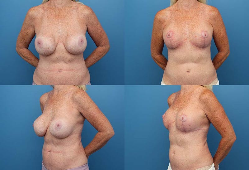 Breast Revision Surgery Before & After Gallery - Patient 2158868 - Image 1