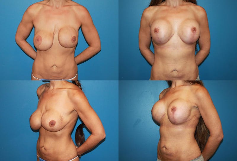 Breast Revision Surgery Gallery - Patient 2158869 - Image 1
