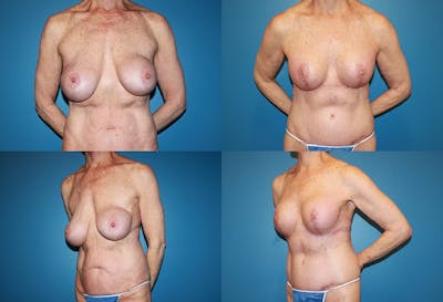 Correction of Long Term Changes Associated with Implants on Top of the Muscle Before & After Gallery - Patient 2393927 - Image 1