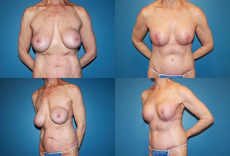 Correction of Long Term Changes Associated with Implants on Top of the Muscle Before & After Gallery - Patient 2393927 - Image 1