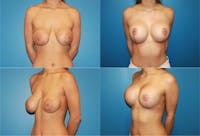 Correction of Long Term Changes Associated with Implants on Top of the Muscle Gallery - Patient 2393930 - Image 1