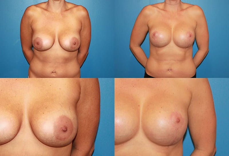 Breast Revision Surgery Before & After Gallery - Patient 2158876 - Image 1