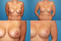 Enlarged Areola Before & After Gallery - Patient 2394104 - Image 1