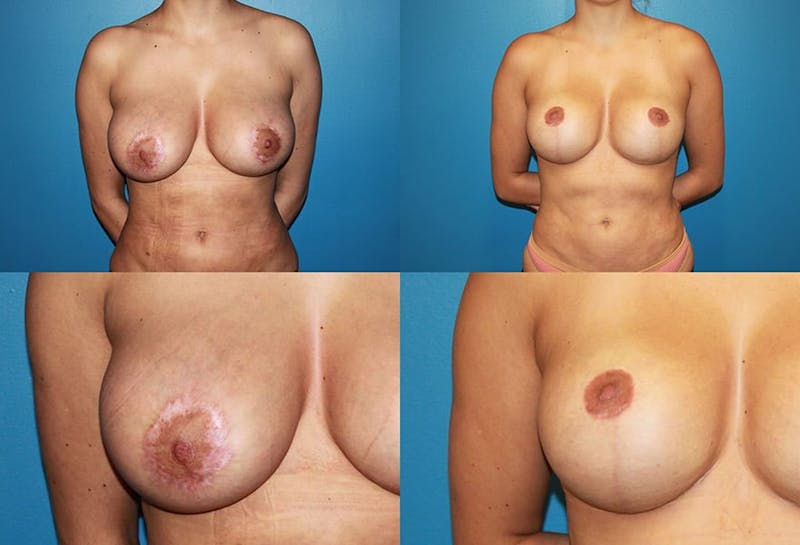 Enlarged Areola Before & After Gallery - Patient 2394105 - Image 1