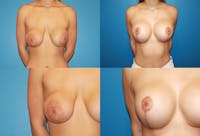 Breast Revision Surgery Before & After Gallery - Patient 2158884 - Image 1