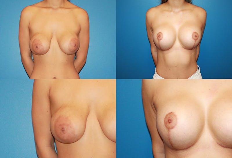 Enlarged Areola Before & After Gallery - Patient 2394106 - Image 1