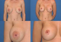 Enlarged Areola Gallery - Patient 2394107 - Image 1