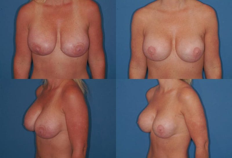 Breast Revision Surgery Before & After Gallery - Patient 2158886 - Image 1