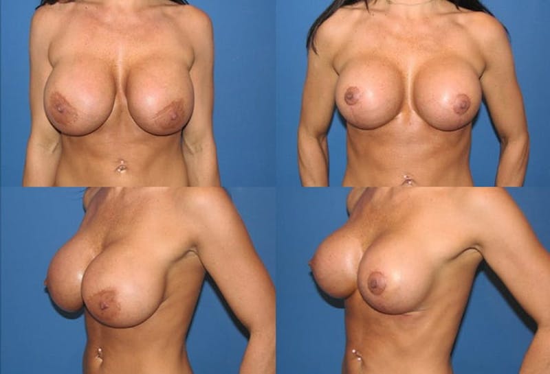 Breast Revision Surgery Before & After Gallery - Patient 2158894 - Image 1