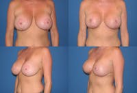 Enlarged Areola Before & After Gallery - Patient 2394111 - Image 1