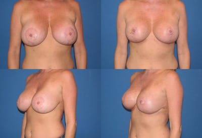 Enlarged Areola Before & After Gallery - Patient 2394111 - Image 1