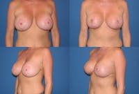 Breast Revision Surgery Before & After Gallery - Patient 2158896 - Image 1