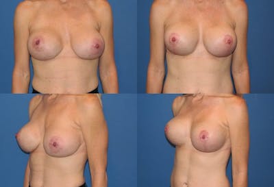Breast Revision Surgery Before & After Gallery - Patient 2158897 - Image 1
