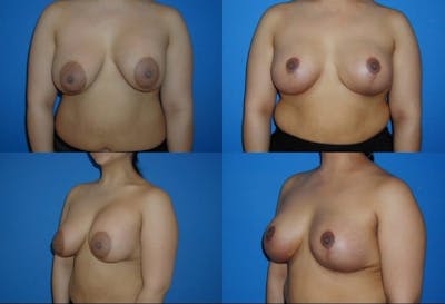 Breast Revision Surgery Before & After Gallery - Patient 2158901 - Image 1