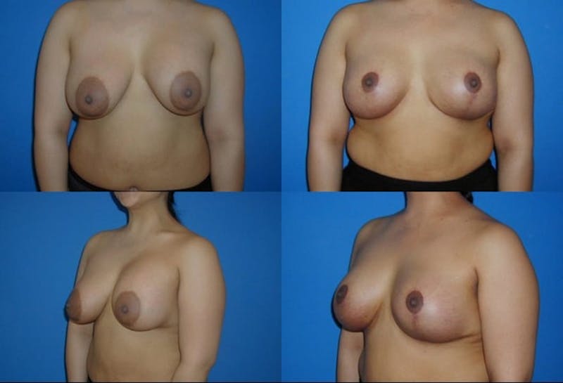 Enlarged Areola Before & After Gallery - Patient 2394113 - Image 1