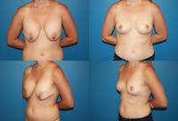 Removal of Breast Implants and Mastopexy Before & After Gallery - Patient 2394212 - Image 1
