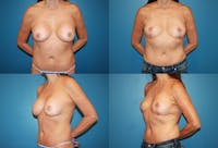 Breast Revision Surgery Before & After Gallery - Patient 2158911 - Image 1