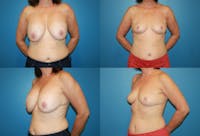 Breast Revision Surgery Before & After Gallery - Patient 2158922 - Image 1