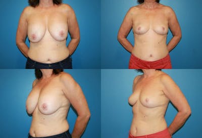 Breast Revision Surgery Before & After Gallery - Patient 2158922 - Image 1