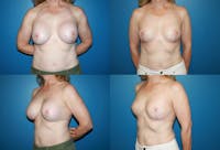 Breast Revision Surgery Before & After Gallery - Patient 2158923 - Image 1