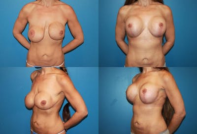 Breast Revision