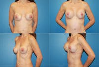 Breast Revision Surgery Before & After Gallery - Patient 2158930 - Image 1