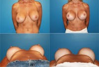 Breast Revision Surgery Before & After Gallery - Patient 2158931 - Image 1