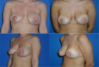 Breast Revision Surgery Before & After Gallery - Patient 2158933 - Image 1