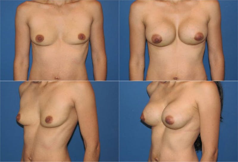 Breast Revision Surgery Before & After Gallery - Patient 2158934 - Image 1