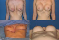 Breast Revision Surgery Before & After Gallery - Patient 2158935 - Image 1