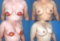 Breast Revision Surgery Before & After Gallery - Patient 2158937 - Image 1