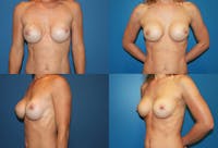 Breast Revision Surgery Before & After Gallery - Patient 2158939 - Image 1