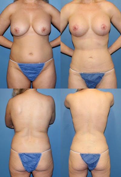 Liposuction Before & After Gallery - Patient 2158948 - Image 1