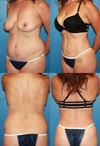Liposuction: Female Before & After Gallery - Patient 2394707 - Image 1