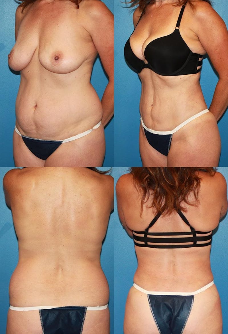 Liposuction: Female Before & After Gallery - Patient 2394707 - Image 1