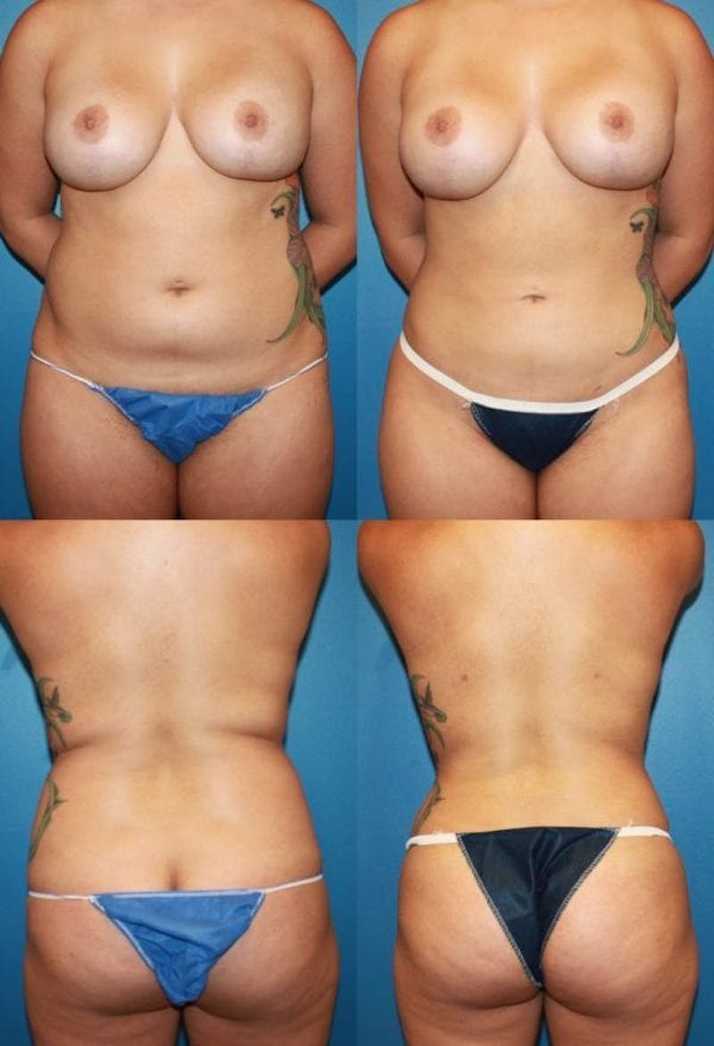 Liposuction Gallery - Patient 2158951 - Image 1